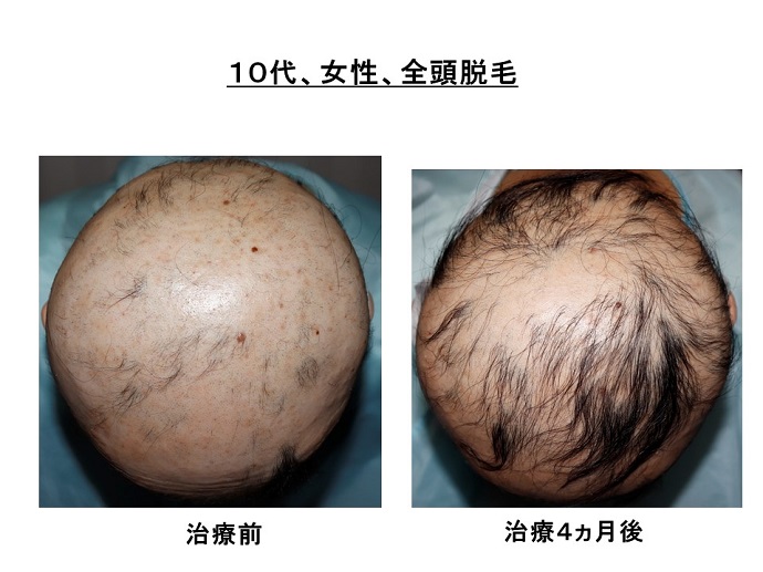円形脱毛症　病院